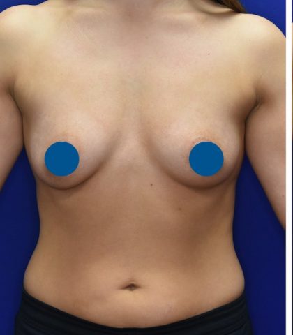 Breast Augmentation Before & After Patient #3588