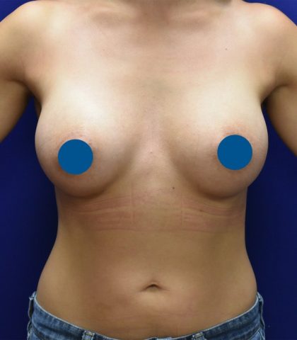Breast Augmentation Before & After Patient #3588