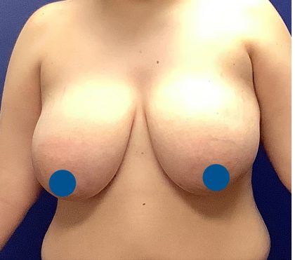 Breast Reduction Before & After Patient #3596