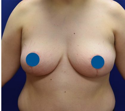 Breast Reduction Before & After Patient #3596