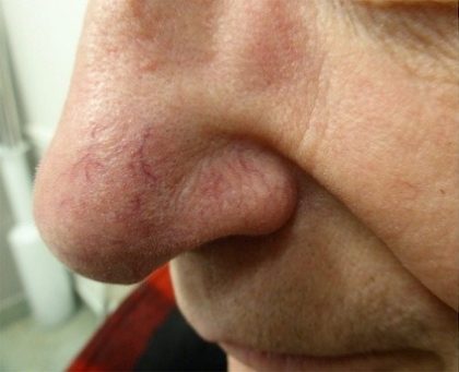 Lumecca Before & After Patient #3655