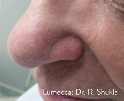 Lumecca Before & After Patient #3655