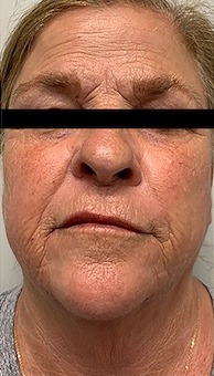 Morpheus8 Before & After Patient #3619