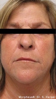 Morpheus8 Before & After Patient #3619