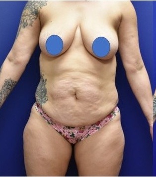 Mommy Makeover Before & After Patient #3579
