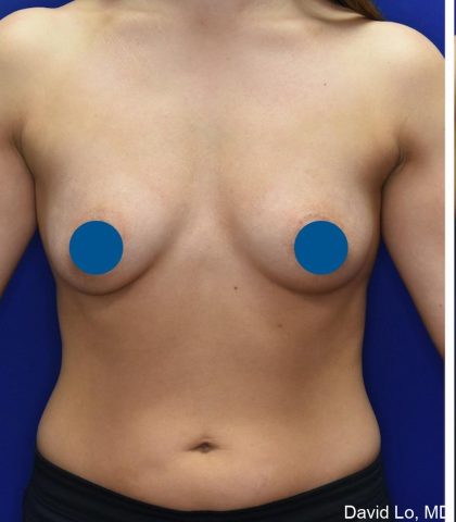 Breast Augmentation Before & After Patient #3588