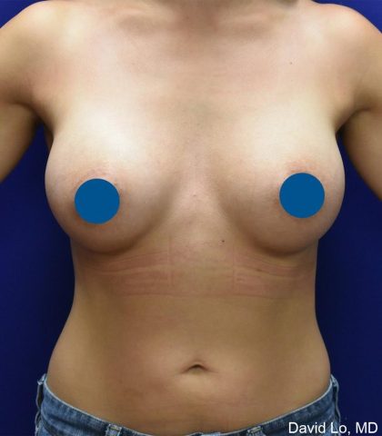 Breast Augmentation Before & After Patient #3588