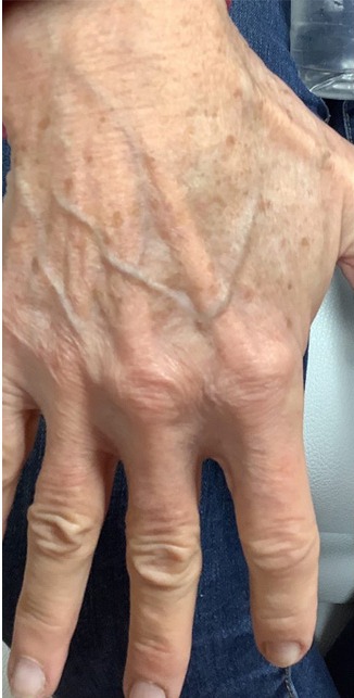 Lumecca Before & After Patient #3673