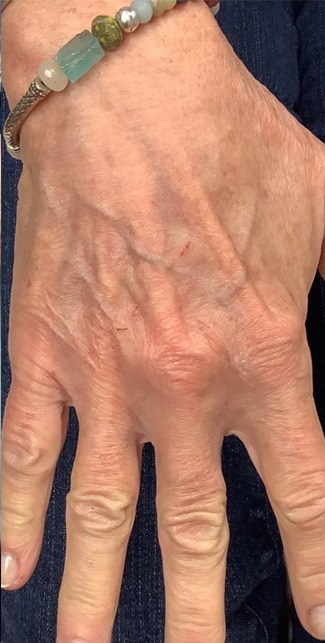 Lumecca Before & After Patient #3673