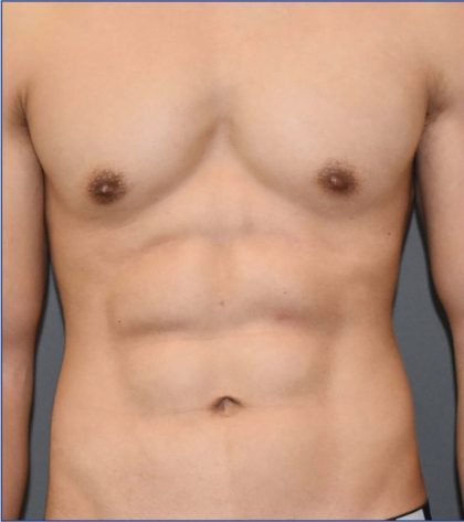 Vaser Lipo Before & After Patient #3729