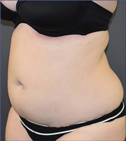 Vaser Lipo Before & After Patient #3719