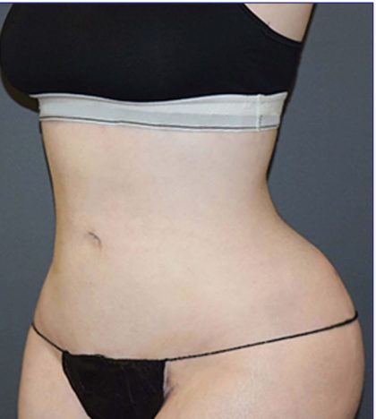 Vaser Lipo Before & After Patient #3719