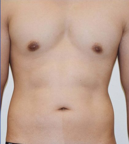 Vaser Lipo Before & After Patient #3729