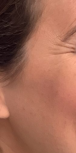 Botox Before & After Patient #3676