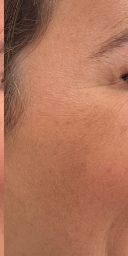 Botox Before & After Patient #3676