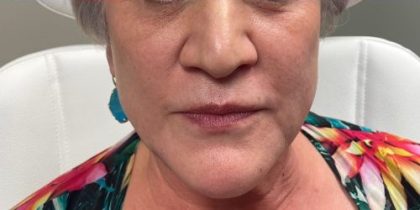 Voluma Before & After Patient #3708