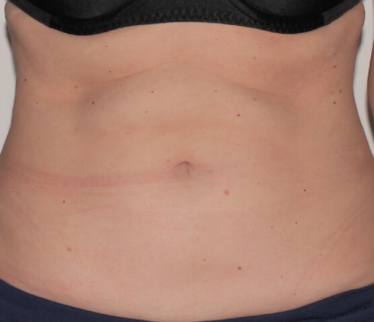 Renuvion Before & After Patient #4098