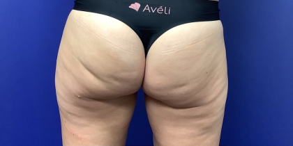 Avéli™ Before & After Patient #4134
