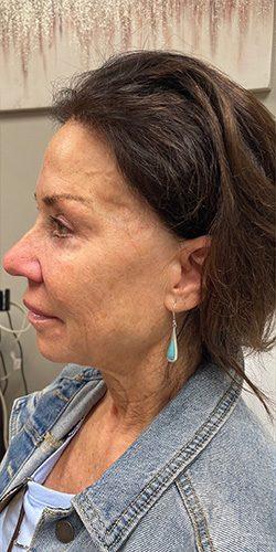 Voluma Before & After Patient #4060