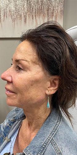 Voluma Before & After Patient #4060