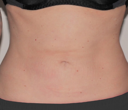 Renuvion Before & After Patient #4098