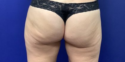 Avéli™ Before & After Patient #4134