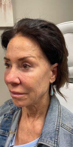 Voluma Before & After Patient #4060
