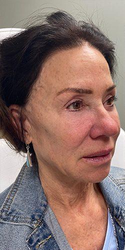 Voluma Before & After Patient #4060