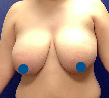 Breast Reduction Before & After Patient #4054
