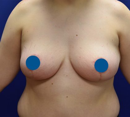 Breast Reduction Before & After Patient #4054