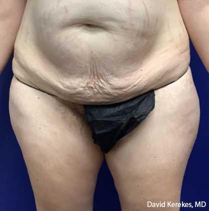 Tummy Tuck Before & After Patient #4538