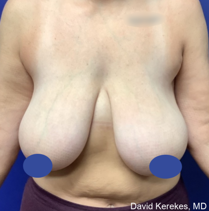 Breast Reduction Before & After Patient #4430