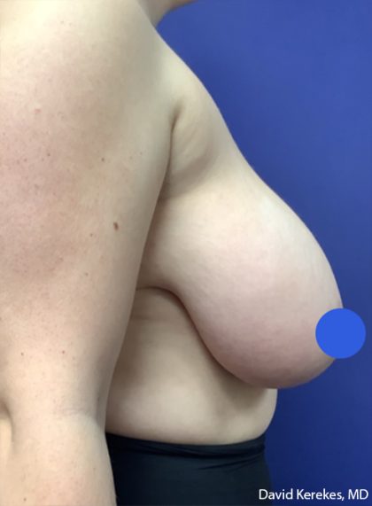 Breast Reduction Before & After Patient #4475