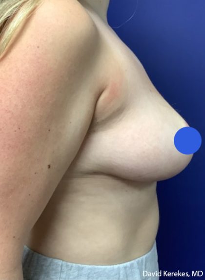Breast Reduction Before & After Patient #4475
