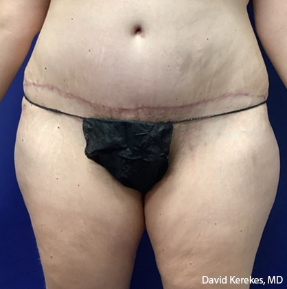 Tummy Tuck Before & After Patient #4538