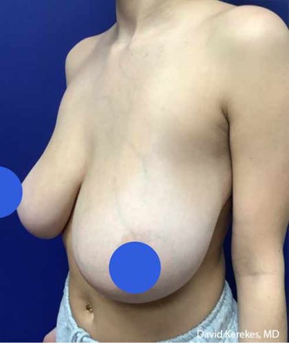 Breast Reduction Before & After Patient #4449