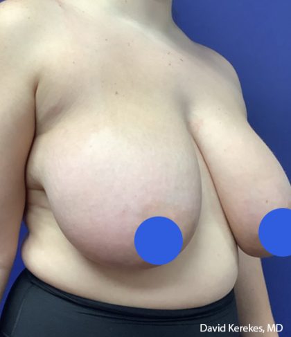 Breast Reduction Before & After Patient #4475