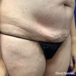Tummy Tuck Before & After Patient #4538