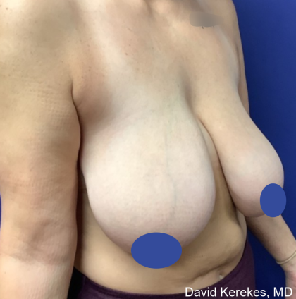 Breast Reduction Before & After Patient #4430
