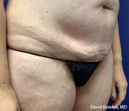 Tummy Tuck Before & After Patient #4538