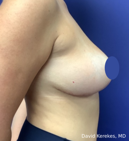 Breast Reduction Before & After Patient #4417