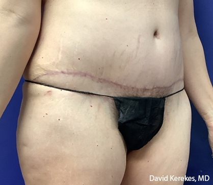 Tummy Tuck Before & After Patient #4538