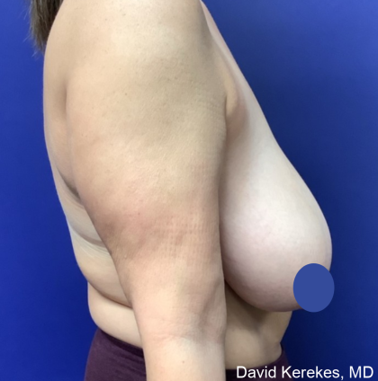 Breast Reduction Before & After Patient #4430