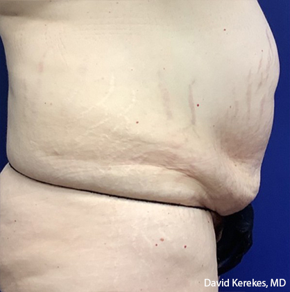 Tummy Tuck Before & After Patient #4538