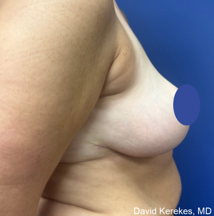 Breast Reduction Before & After Patient #4430