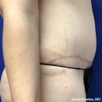 Tummy Tuck Before & After Patient #4538