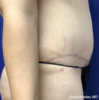 Tummy Tuck Before & After Patient #4538