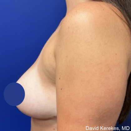 Breast Reduction Before & After Patient #4555