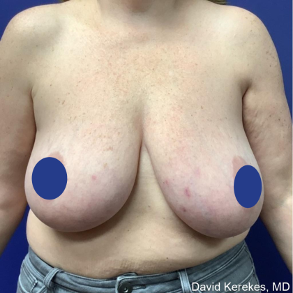 Breast Lift Before & After Patient #4541