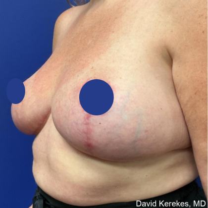 Breast Lift Before & After Patient #4541